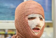 جلالی: سالانه حدود 300 هزار نفر به مراکز سوختگی کشور مراجعه می کنند - خبرگزاری مهر ایران و جهان