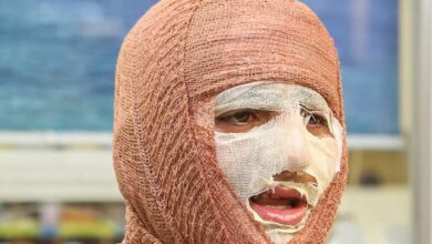 جلالی: سالانه حدود 300 هزار نفر به مراکز سوختگی کشور مراجعه می کنند - خبرگزاری مهر ایران و جهان