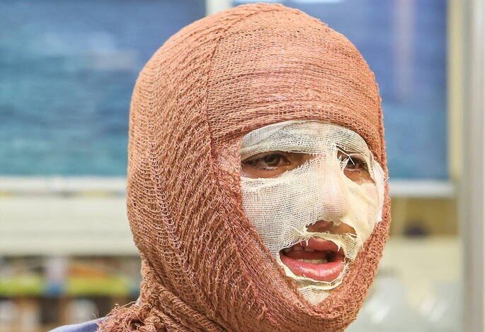 جلالی: سالانه حدود 300 هزار نفر به مراکز سوختگی کشور مراجعه می کنند - خبرگزاری مهر ایران و جهان