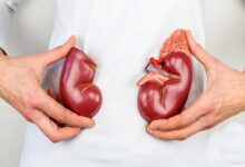 پیشگیری از بیماری های کلیوی با چکاپ های منظم - خبرگزاری مهر ایران و جهان