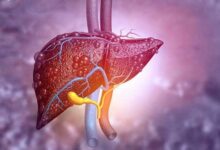 کدام علائم نشانه کبد چرب است؟