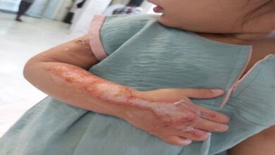 توصیه هایی برای پیشگیری از سوختگی - خبرگزاری مهر | اخبار ایران و جهان