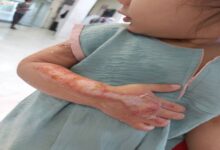 توصیه هایی برای پیشگیری از سوختگی - خبرگزاری مهر ایران و جهان