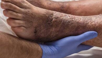 بدون درد زخم در بیماران دیابتی نشانه پیشرفت آسیب عصبی است - خبرگزاری مهر ایران و جهان