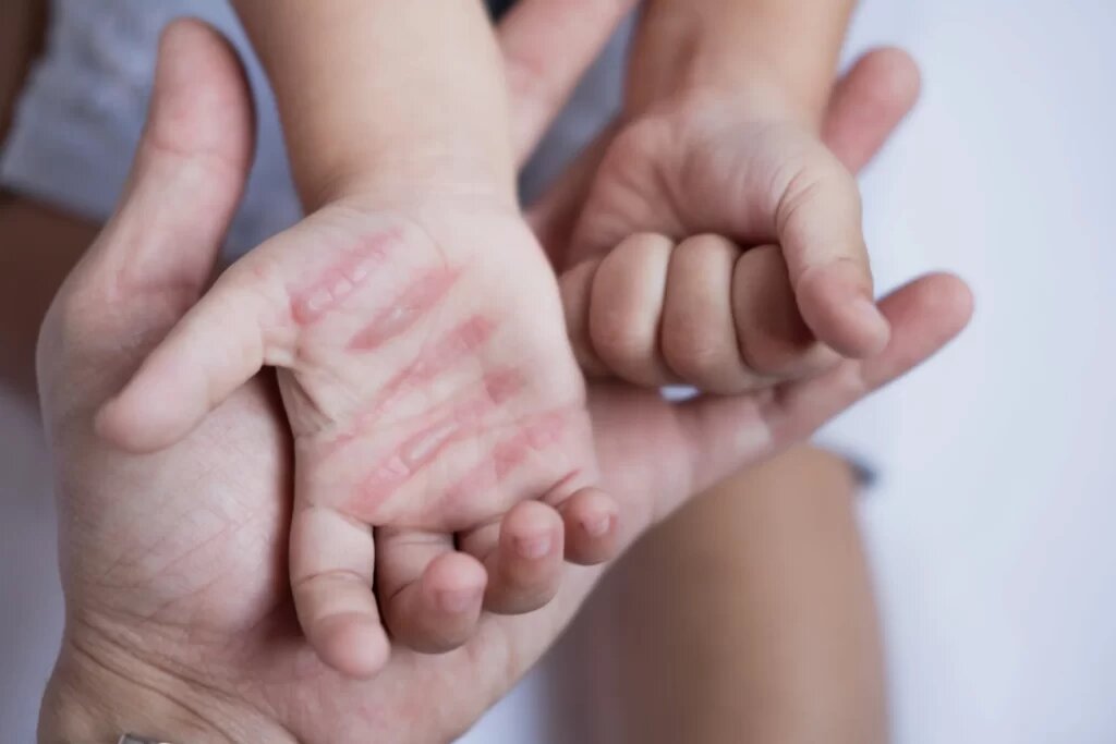 از کمبود تخت تا هزینه های سنگین درمان؛ روایت سوختگی در ایران