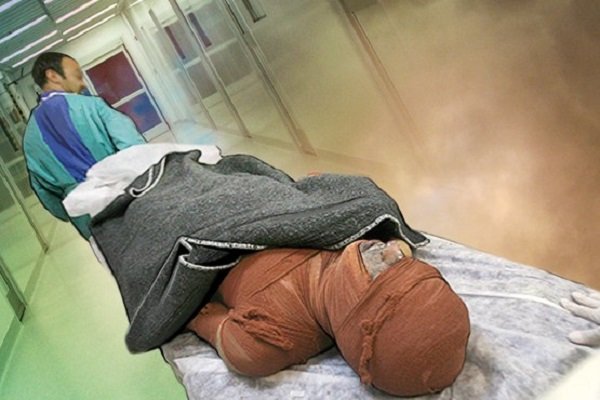 کمبود هزار تخت بیمارستانی سوختگی در کشور - خبرگزاری مهر ایران و جهان
