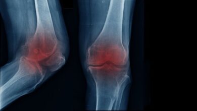 آیا پیاده روی و ورزش باعث آرتروز زانو می شود؟ / علائم آرتروز زانو چیست؟