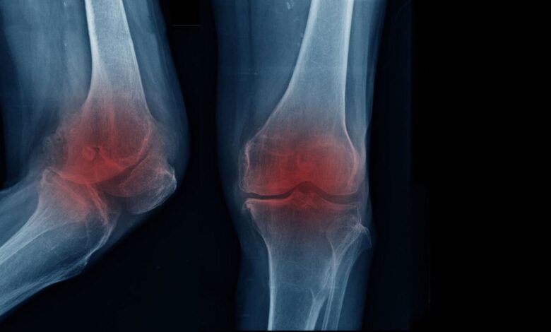 آیا پیاده روی و ورزش باعث آرتروز زانو می شود؟ / علائم آرتروز زانو چیست؟