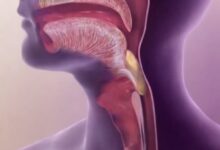 درمان اختلال بلع چیست؟