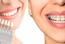 آنچه باید پیش از بلیچینگ دندان بدانید/ زیبایی لبخند بدون آسیب به دندان