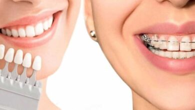 آنچه باید پیش از بلیچینگ دندان بدانید/ زیبایی لبخند بدون آسیب به دندان