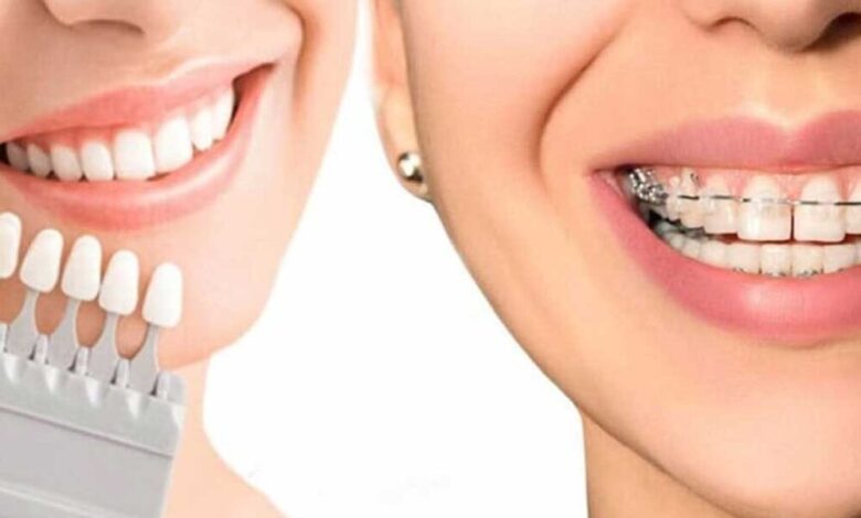 آنچه باید پیش از بلیچینگ دندان بدانید/ زیبایی لبخند بدون آسیب به دندان