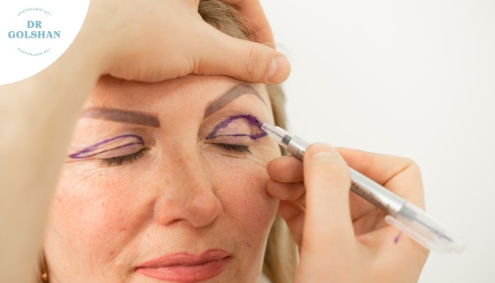 آمادگی های قبل از بلفاروپلاستی