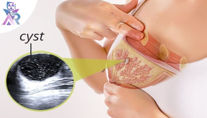 وجود توده یا سفتی غیرطبیعی در پستان