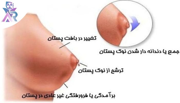 نشانههای شایع قابل لمس در پستان