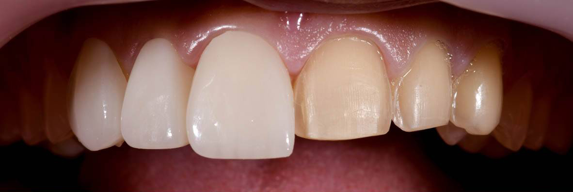 Laminate Veneer - Lumos Dental Clinic - Dental Centre Turkey