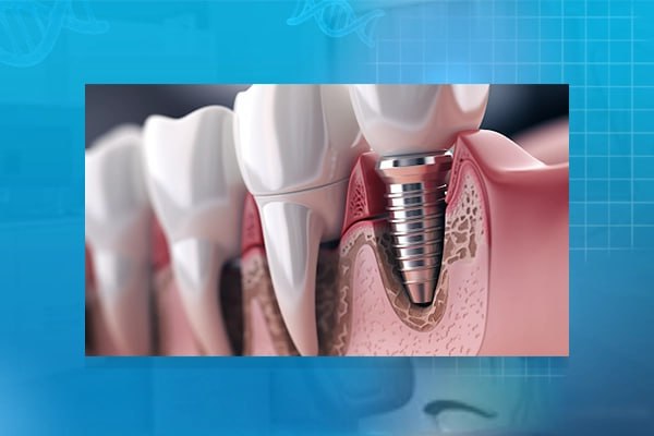 بهترین دندانپزشکی ایمپلنت