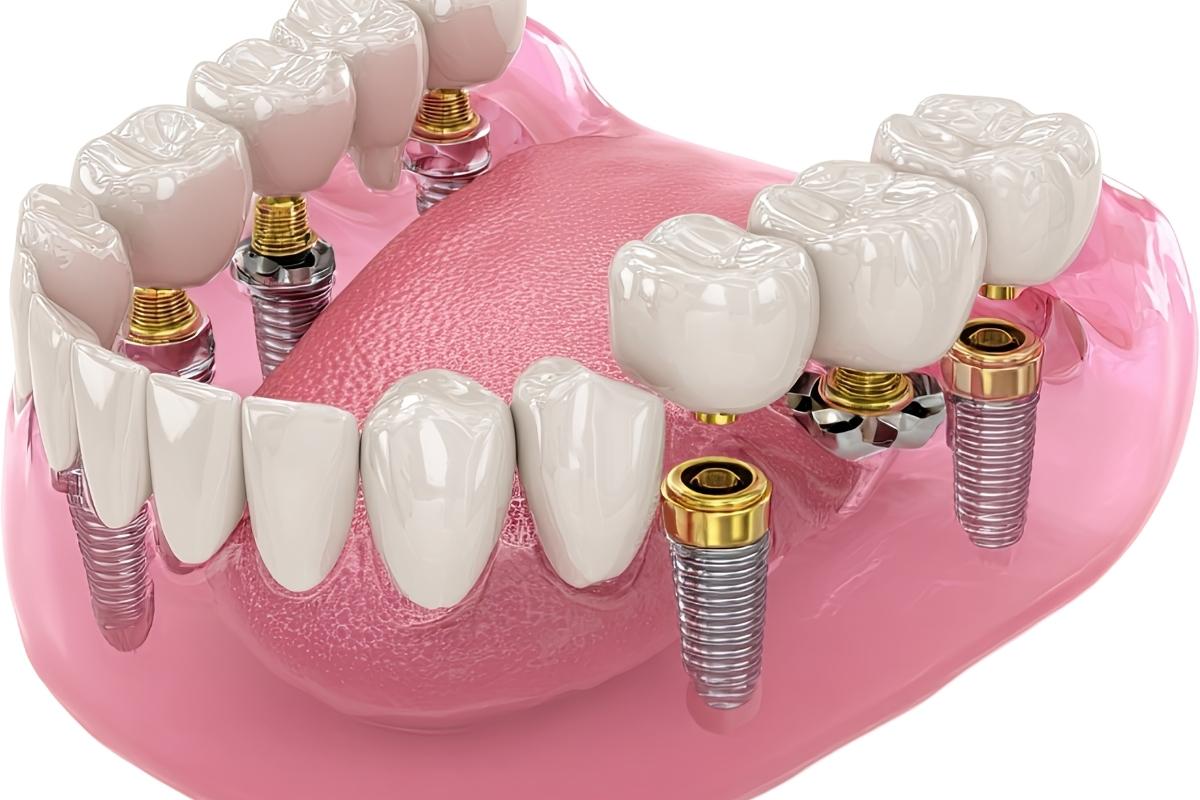 مهمترین معیار انتخاب مرکز ایمپلنت