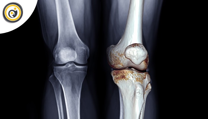 روشهای تشخیص علت زانو درد