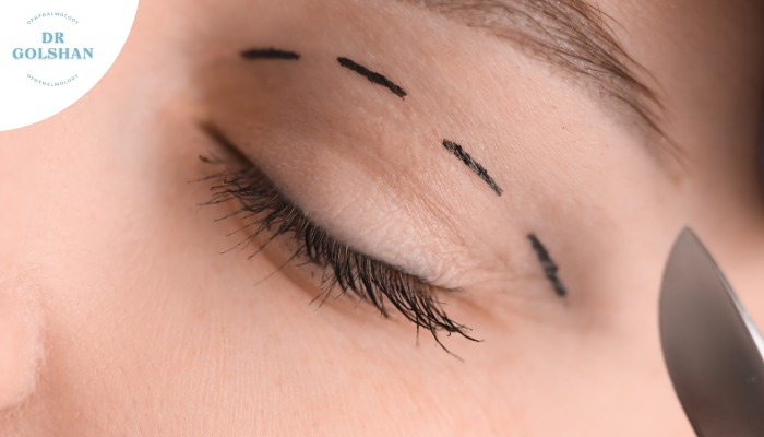 4 نکته که قبل از جراحی پلک باید بدانید!