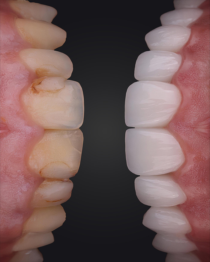 Laminate Veneer Prices in Turkey: Procedure & Cost