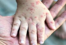 ثبت ۷۱۴ مورد «سرخک» در کشور؛ اوج ابتلا در اردیبهشت ماه - خبرگزاری مهر ایران و جهان