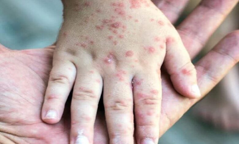 ثبت ۷۱۴ مورد «سرخک» در کشور؛ اوج ابتلا در اردیبهشت ماه - خبرگزاری مهر ایران و جهان