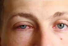 عفونت انگلی «آکانتامبا»؛ خطر تشخیص اشتباه و از دست رفتن دائم بینایی