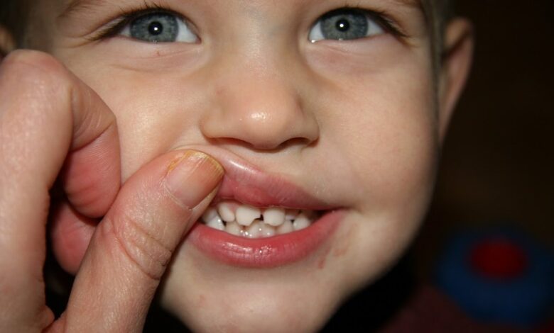 علل پوسیدگی دندان در کودکان چیست / چگونه از این عارضه جلوگیری کنیم؟