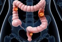 علل سرطان روده بزرگ را بشناسیم - خبرگزاری مهر ایران و جهان