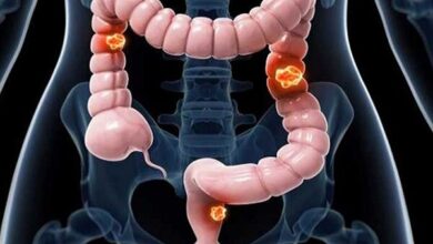 علل سرطان روده بزرگ را بشناسیم - خبرگزاری مهر ایران و جهان