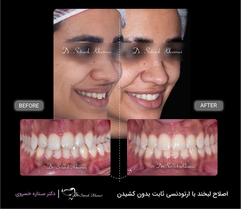 اصلاح لبخند با ارتودنسی نامرئی