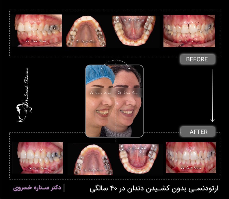 ارتودنسی بدون کشیدن دندان در 40 سالگی