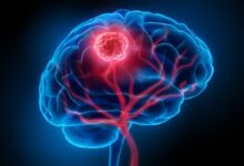 آیا تومور مغزی در کودکان قابل درمان است؟