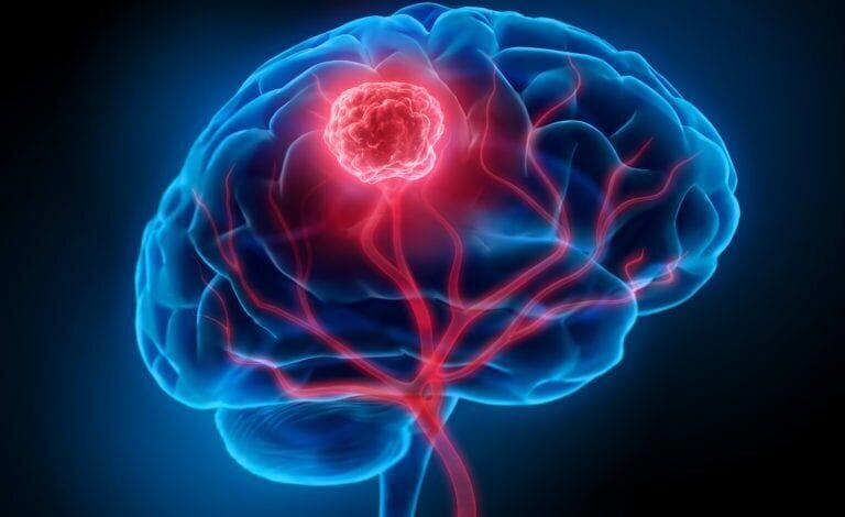 آیا تومور مغزی در کودکان قابل درمان است؟