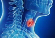 افزایش تشخیص بدخیمی های تیروئید - خبرگزاری مهر ایران و جهان