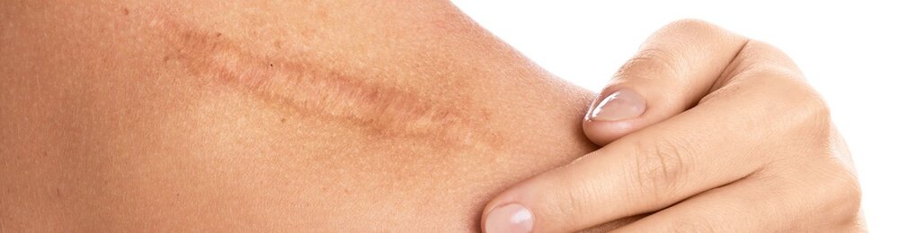 لیزر موهای زائد برای پوست آسیب دیده