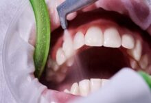 جرمگیری روشی موثر برای پیشگیری از پوسیدگی و بیماری لثه - خبرگزاری مهر ایران و جهان