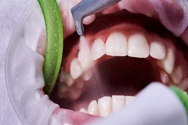 جرمگیری روشی موثر برای پیشگیری از پوسیدگی و بیماری لثه - خبرگزاری مهر ایران و جهان