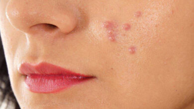 از ارتباط بین آکنه‌های پوستی با قند و شکر چه می‌دانید؟