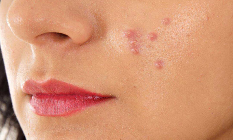 از ارتباط بین آکنه‌های پوستی با قند و شکر چه می‌دانید؟