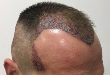 آشنایی با روش های کاشت مو