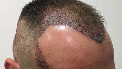 آشنایی با روش های کاشت مو