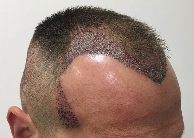 آشنایی با روش های کاشت مو