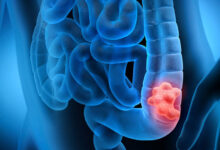 نوشیدن مشروبات الکلی خطر ابتلا به سرطان روده بزرگ را افزایش می دهد - خبرگزاری مهر ایران و جهان