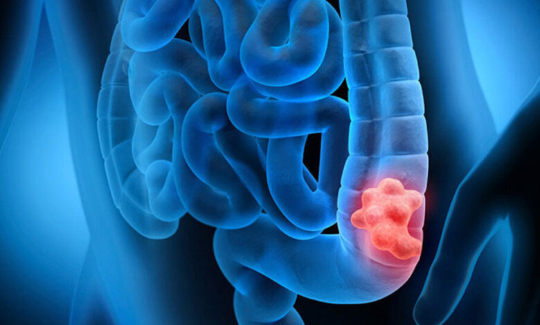 نوشیدن مشروبات الکلی خطر ابتلا به سرطان روده بزرگ را افزایش می دهد - خبرگزاری مهر ایران و جهان