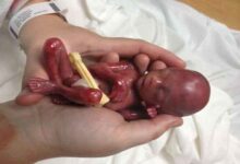 سقط جنین؛ از «صنعت پول سیاه» تا عوارض جسمی و روحی جبران ناپذیر - خبرگزاری مهر ایران و جهان