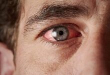 سیاهی چشم چیست و چه علائمی دارد؟ / فشار چشم ارتباطی با فشار خون سیستمیک ندارد