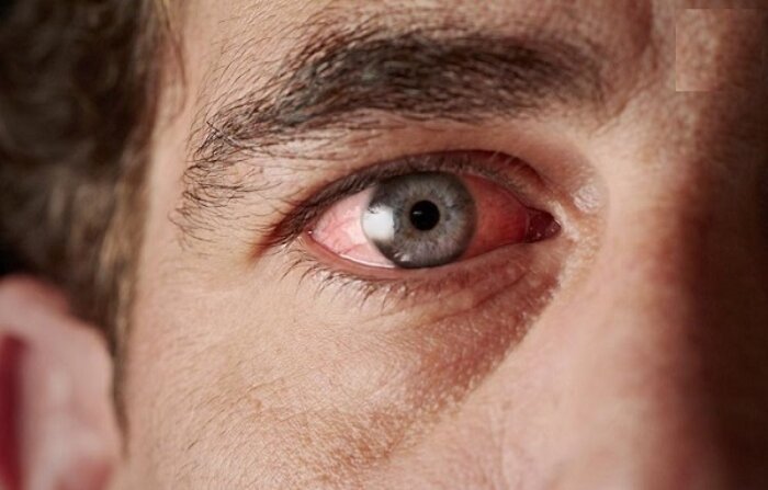 سیاهی چشم چیست و چه علائمی دارد؟ / فشار چشم ارتباطی با فشار خون سیستمیک ندارد