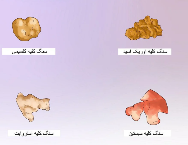 انواع سنگ کلیه